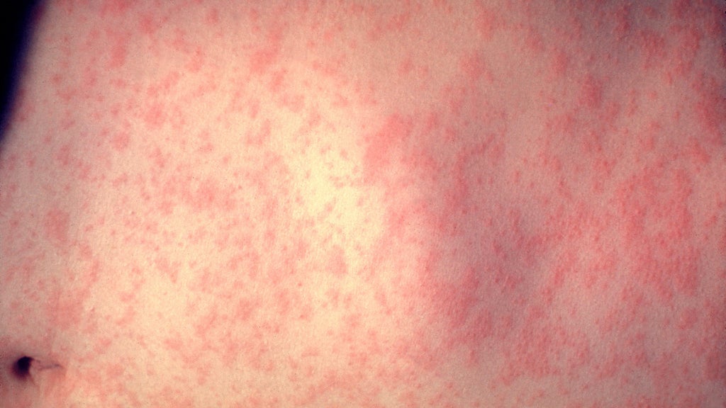 25 cases of measles identified in central, southeastern Minnesota, MDH says — WCCO / CBS Minnesota, Lakeville Health news